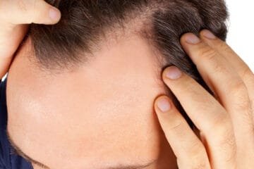 Alopecia Treatment for Baldness
