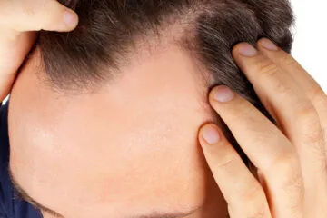 Alopecia Treatment for Baldness