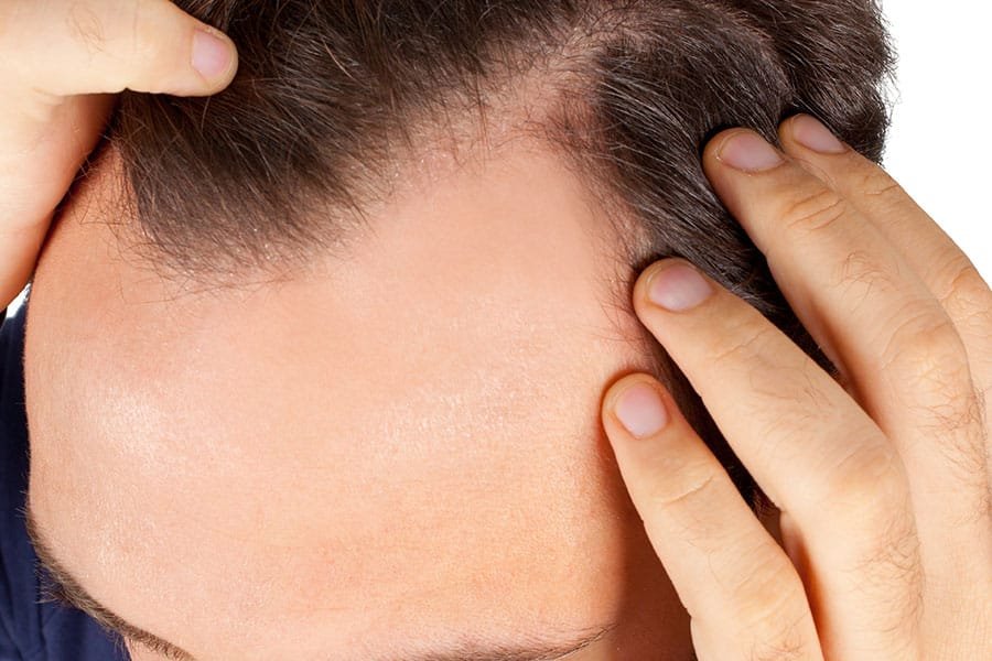 Alopecia Treatment for Baldness