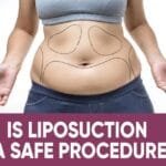 Is Liposuction A Safe Procedure?
