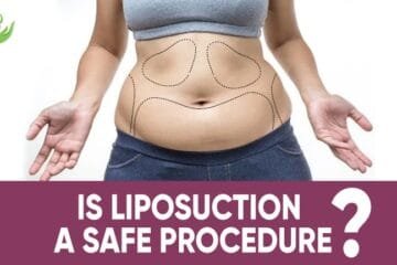 Is Liposuction A Safe Procedure?