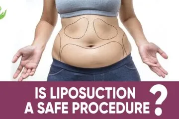 Is Liposuction A Safe Procedure?