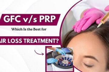 GFC v/s PRP Which Is the Best for Hair Loss Treatment
