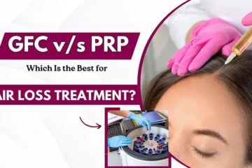 GFC v/s PRP Which Is the Best for Hair Loss Treatment
