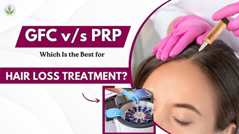 GFC v/s PRP Which Is the Best for Hair Loss Treatment