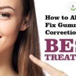How to Absolutely Fix Gummy Smile Correction? Know Best Treatment