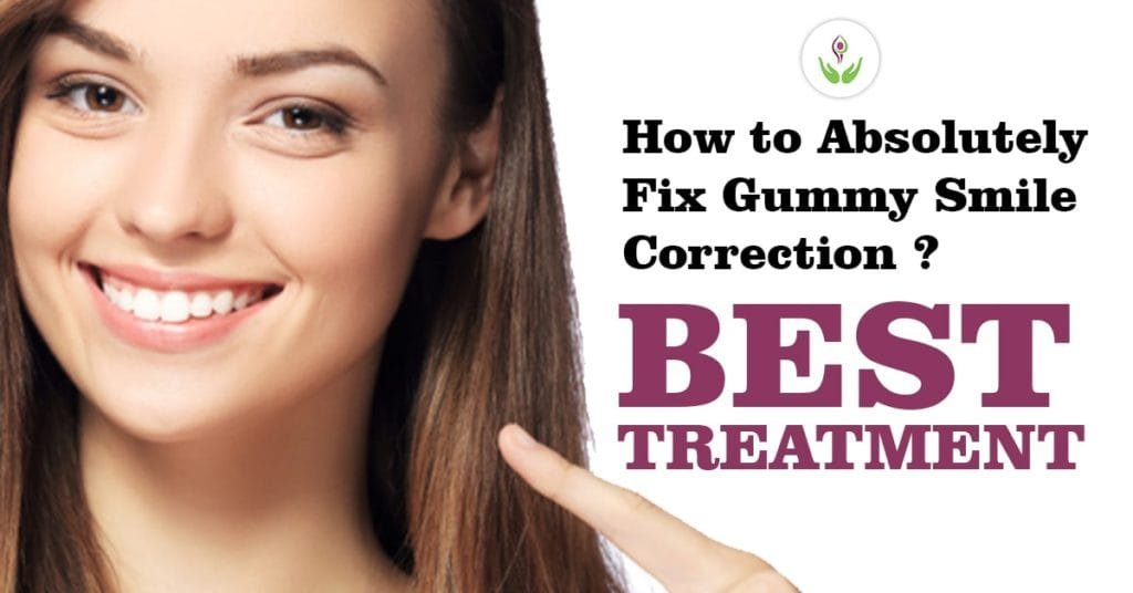 How to Absolutely Fix Gummy Smile Correction? Know Best Treatment