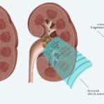 Kidney Stone Treatment in Homeopathy and Ayurveda