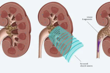 Kidney Stone Treatment in Homeopathy and Ayurveda