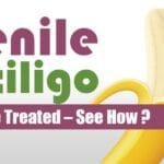 Penile Vitiligo Can Be Treated – See How?