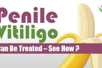 Penile Vitiligo Can Be Treated – See How?