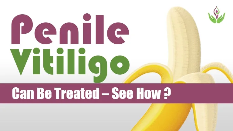 Penile Vitiligo Can Be Treated – See How?