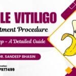 Penile Vitiligo Treatment Procedure Step by Step – A Detailed Guide