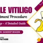 Penile Vitiligo Treatment Procedure Step by Step – A Detailed Guide