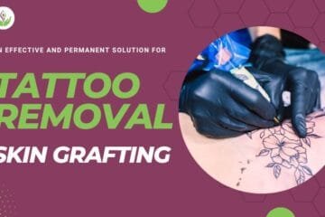 Skin Grafting For Tattoo Removal