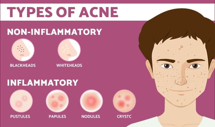 Types of Acne