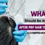 What Should Be Avoided After PRP Hair Treatment
