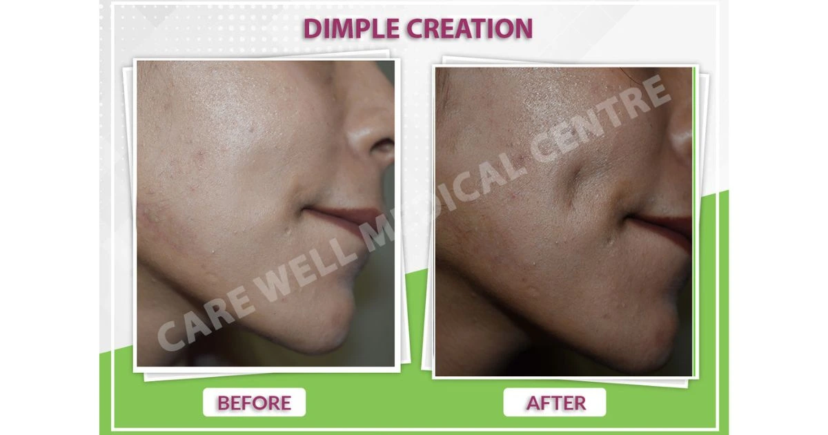 Dimple Creation Surgery in Delhi | Cost, Procedure & Results | Care ...