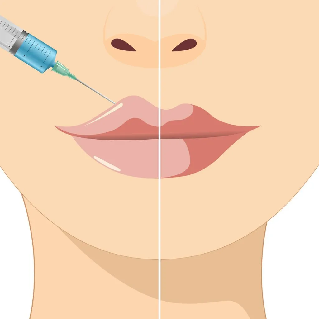 Close-up of dermal filler injection in lips using Juvederm or Restylane for natural lip enhancement in Delhi