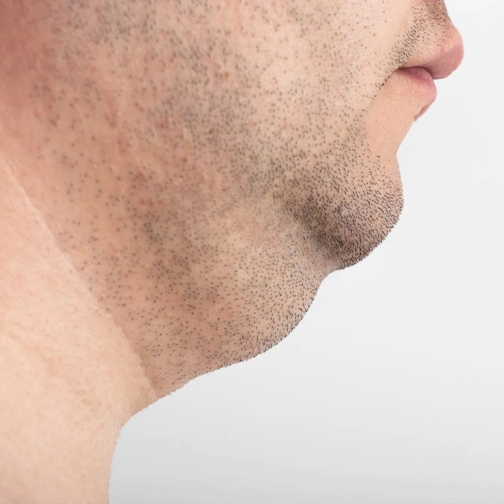 Double Chin Removal