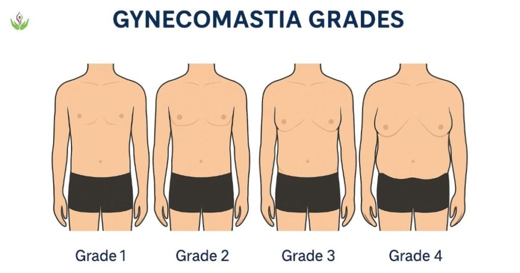 Gynecomastia grades illustration – Grade 1 to Grade 4
