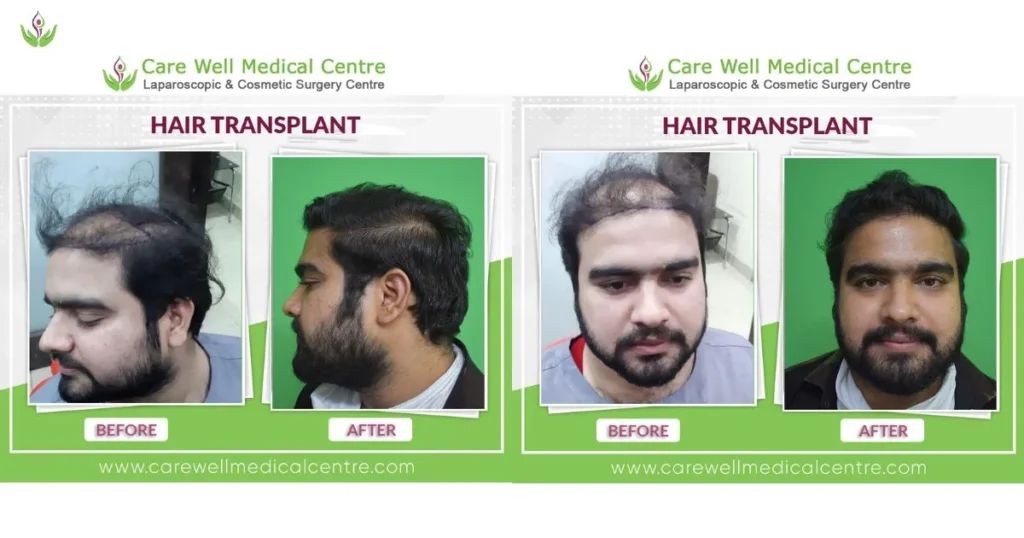Nishant Hair Transplant Before and After Result at Care Well Medical Centre