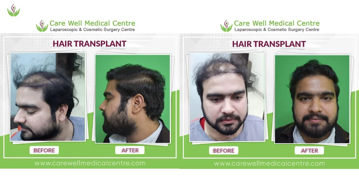 Hair Transplant before and after result in delhi