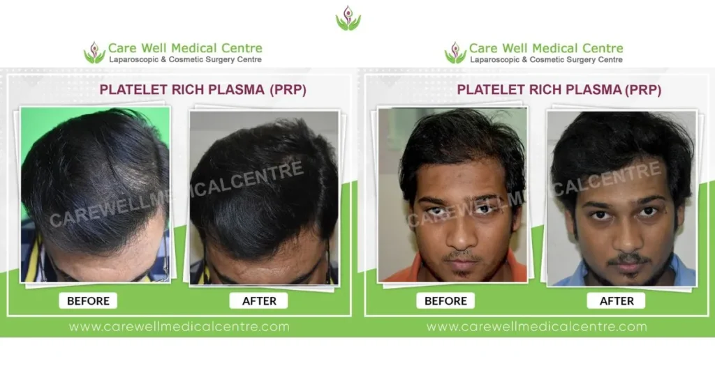 PRP hair loss treatment before and after results in Delhi