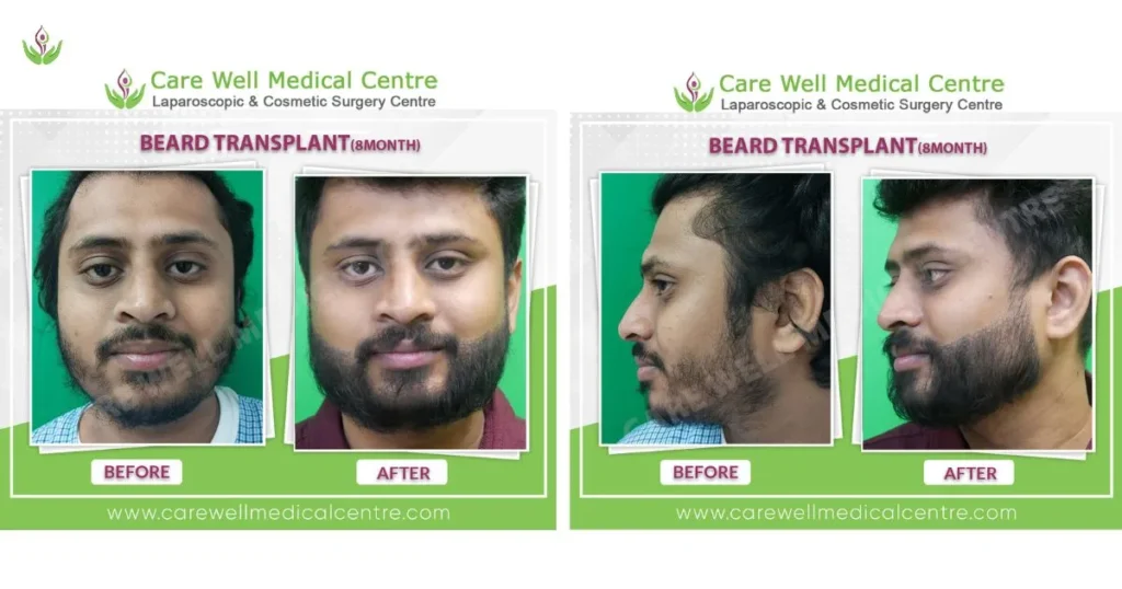 beard transplant before and after result in delhi at care well medical centre