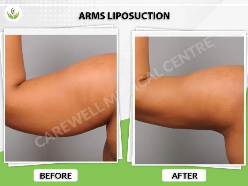 Before and after arm liposuction in Delhi