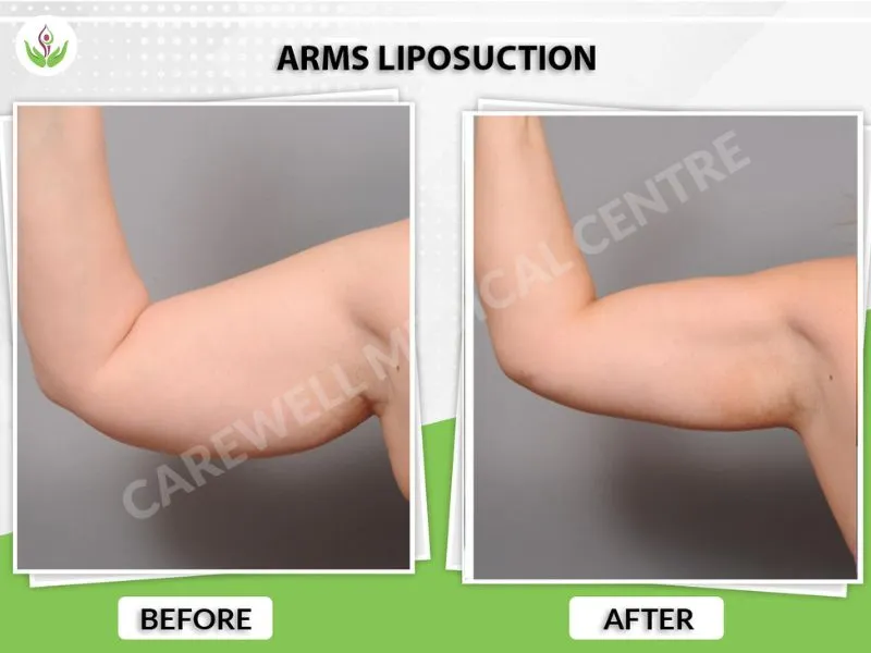 Arm liposuction before and after results Delhi