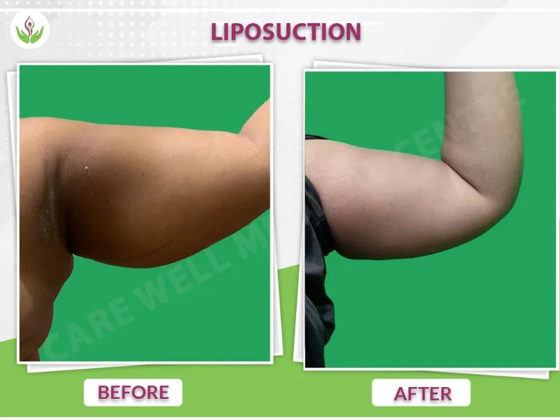 Delhi arm liposuction before and after photo