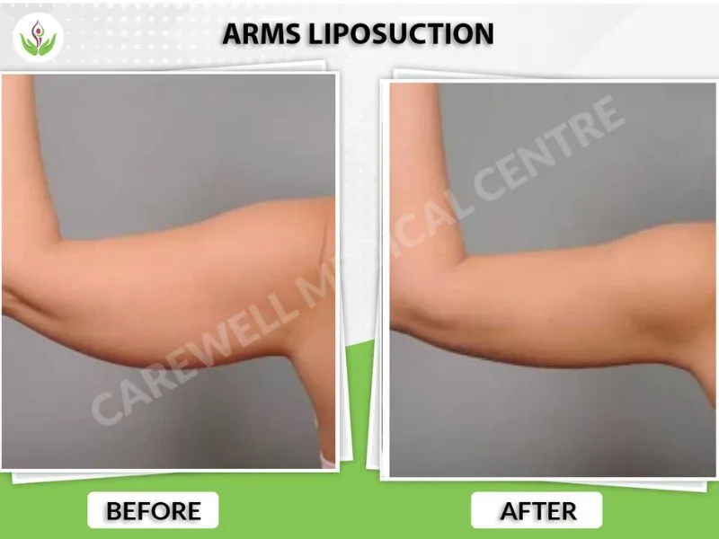 Before and after arm fat removal in Delhi