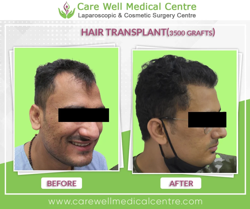 Side-by-side before and after photo of Ashwani showing successful FUT hair transplant with restored hairline and improved hair density.