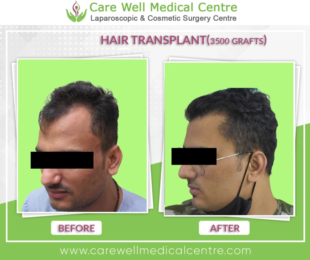 Ashwani’s before and after comparison showing effective FUT hair transplant results with 3500 grafts, enhanced hair volume, and natural hairline restoration.