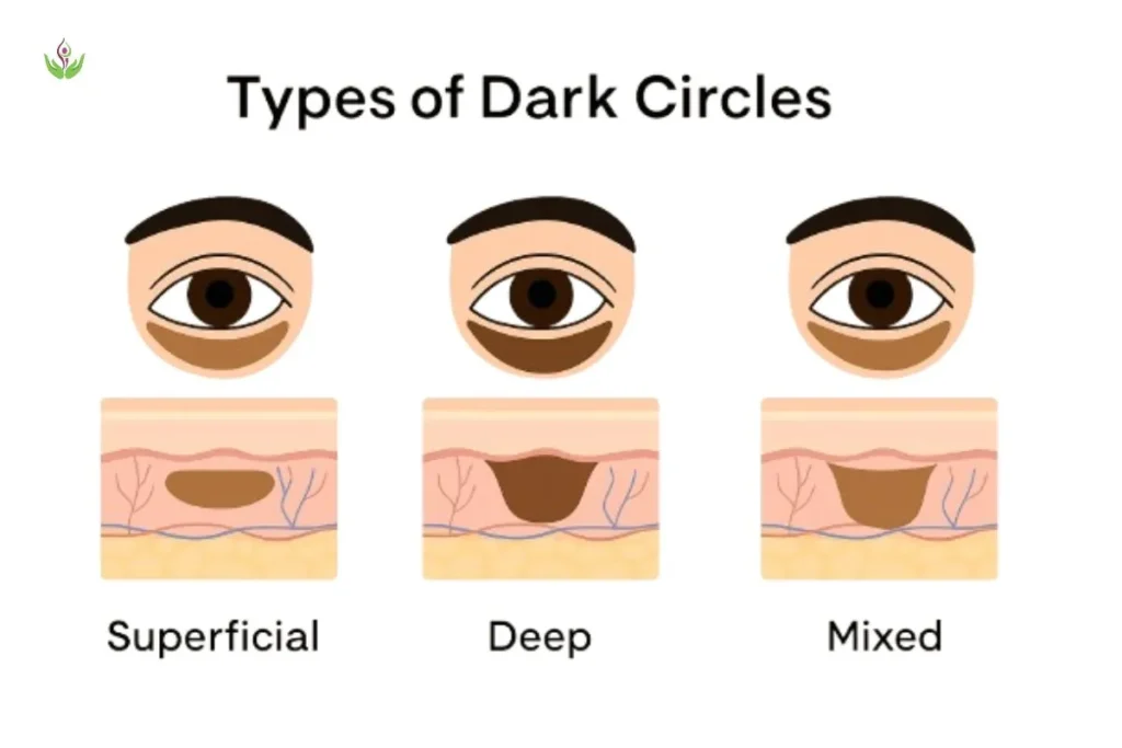 Types of dark circles – superficial, deep, and mixed pigmentation