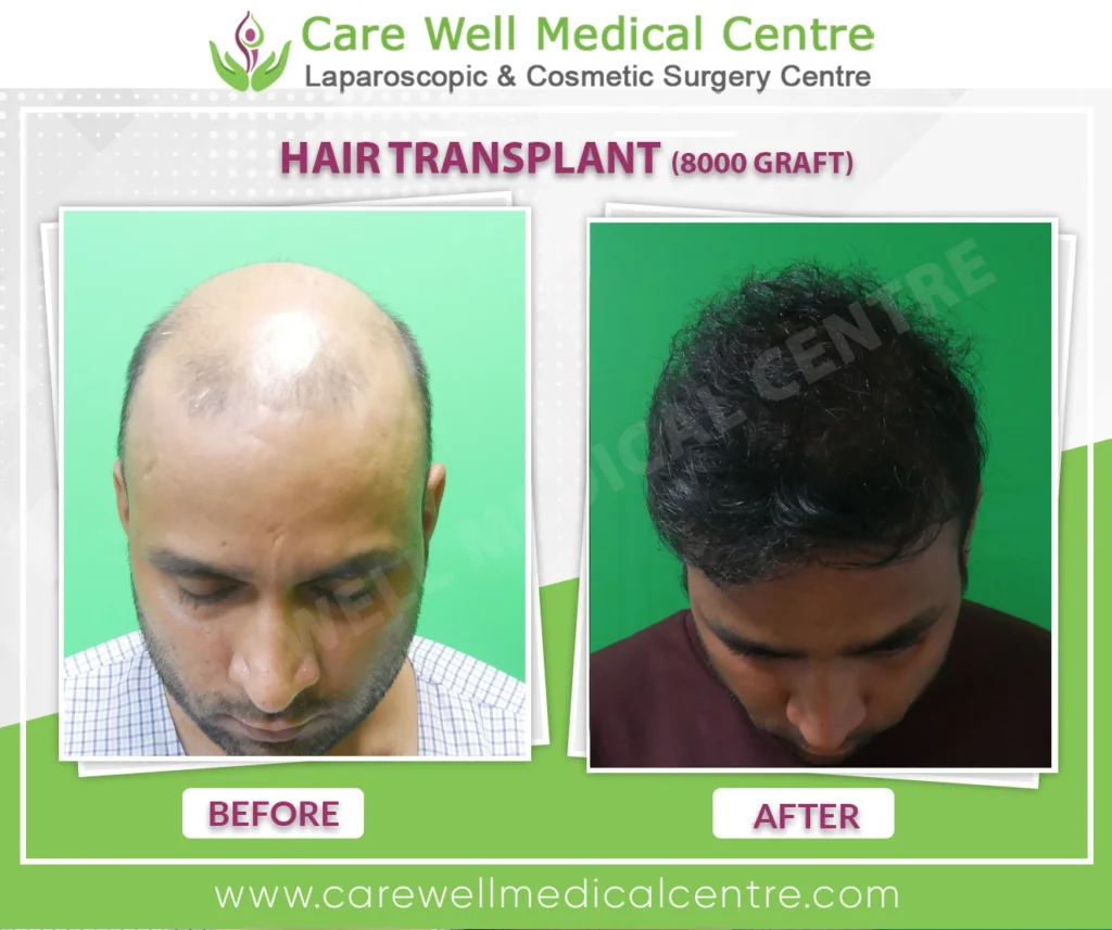 Vijayβs top view showing before hair transplant with thinning crown and after hair transplant with dense hair coverage at Care Well Medical Centre Delhiβ