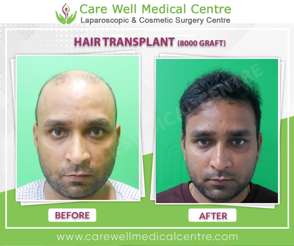 Vijayβs front view showing before hair transplant with receding hairline and after hair transplant with natural, fuller hairline at Care Well Medical Centre Delhi