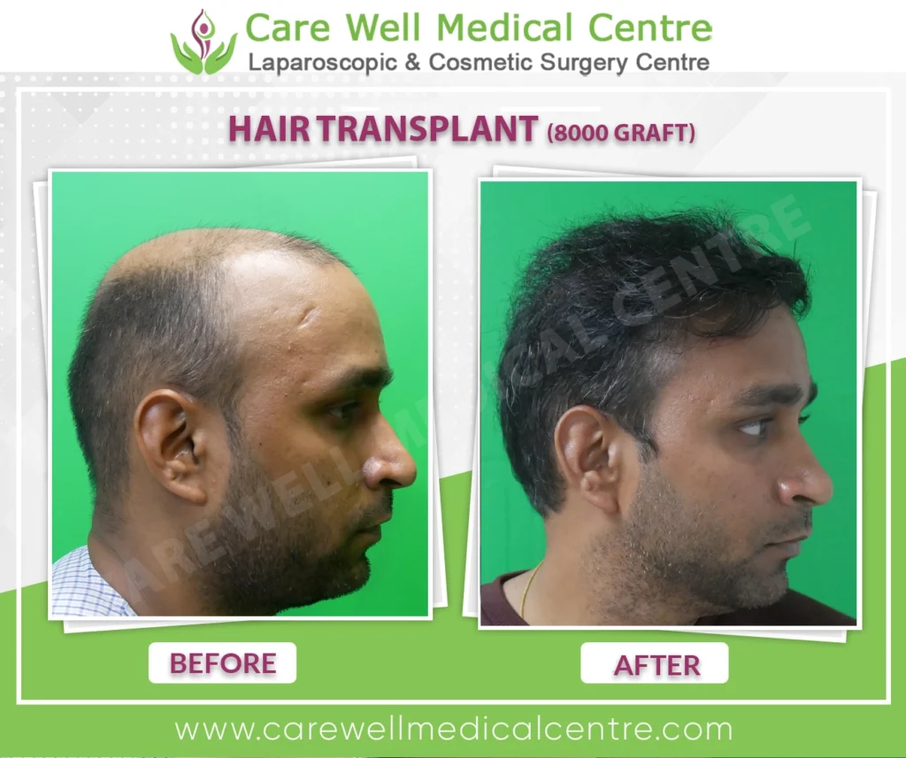Vijayβs side view showing before hair transplant with temple recession and after hair transplant with restored natural hairline at Care Well Medical Centre Delhi
