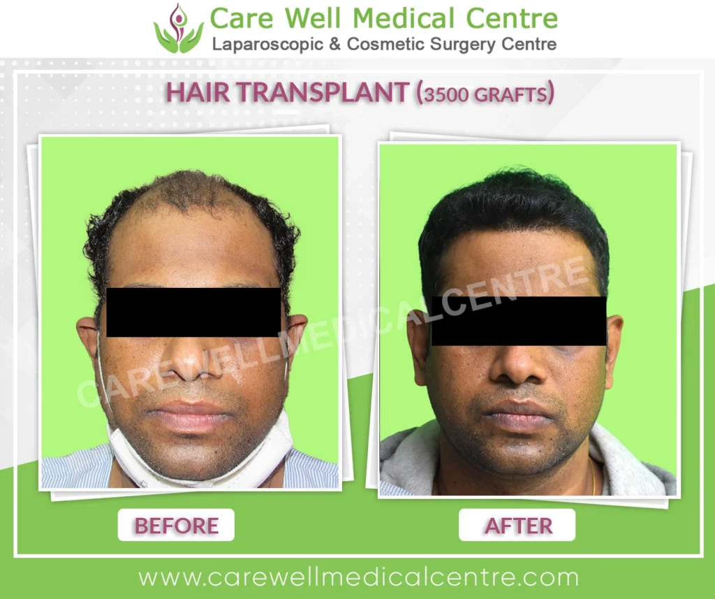 Suresh ka before and after result of FUE hair transplant with 3000 grafts, showing clear improvement in hair density and natural hairline restoration.