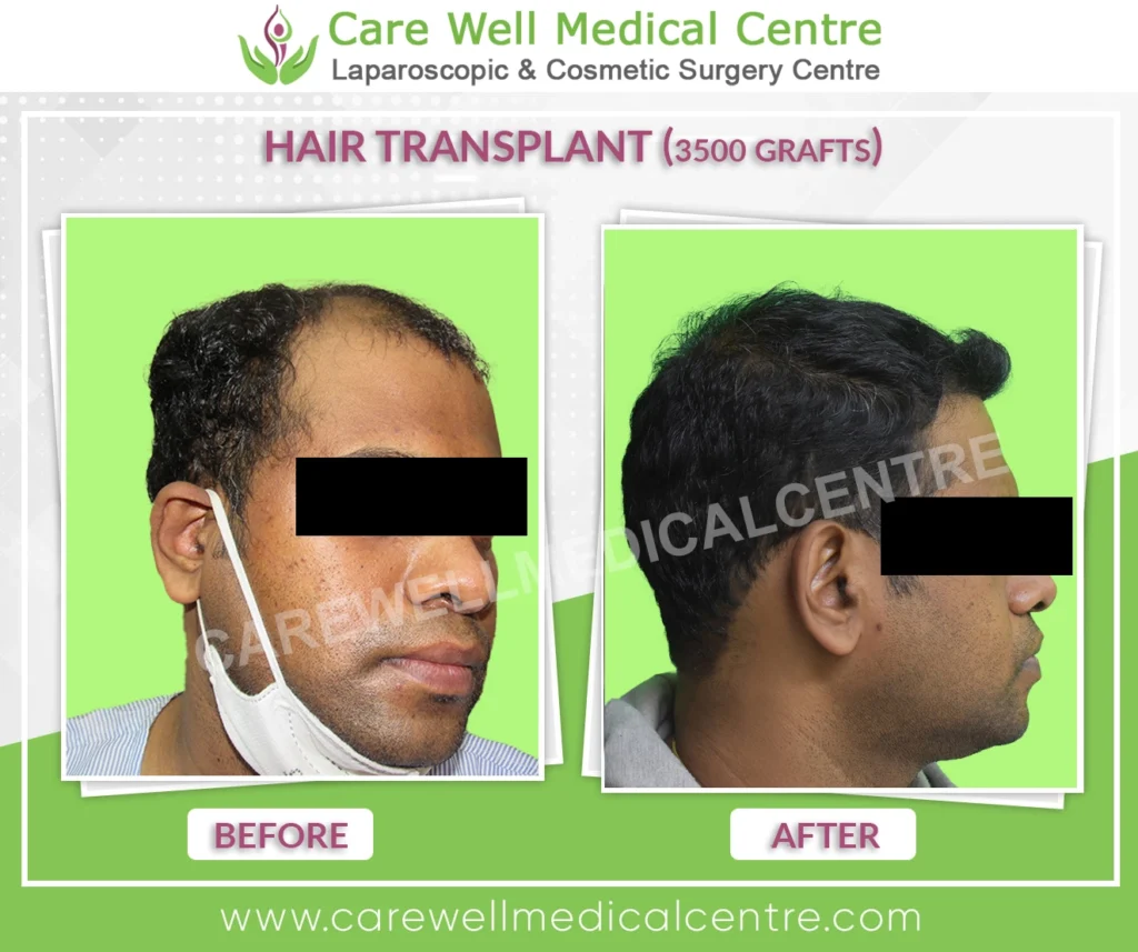 Side-by-side before and after photo of Suresh showing successful FUE hair transplant with 3000 grafts, highlighting restored hairline and improved hair volume.