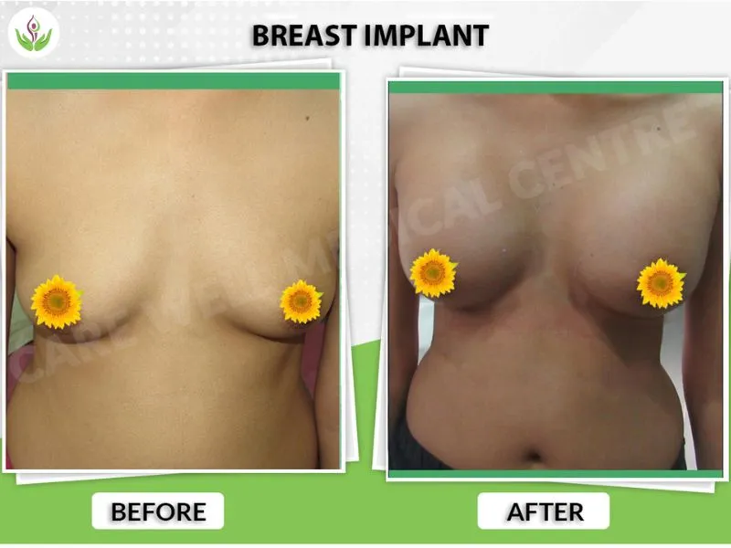 Breast implant before and after result photo in Delhi showing natural enhancement