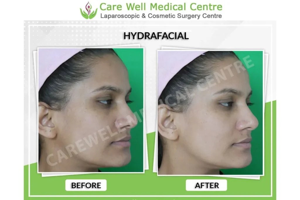 Care Well Medical Centre HydraFacial Results – Visible Skin Rejuvenation in Delhi
