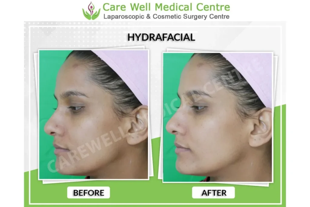 HydraFacial Delhi Before and After – Smooth and Radiant Complexion
