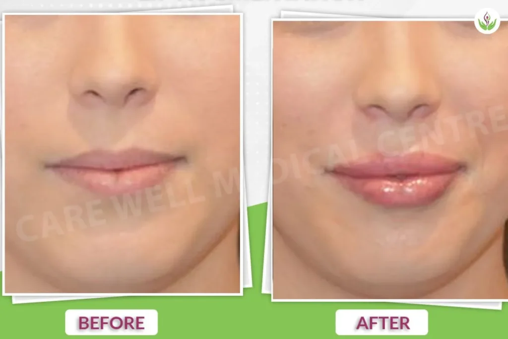 Dermal fillers before and after photo showing results at Care Well Medical Centre in Delhi.
