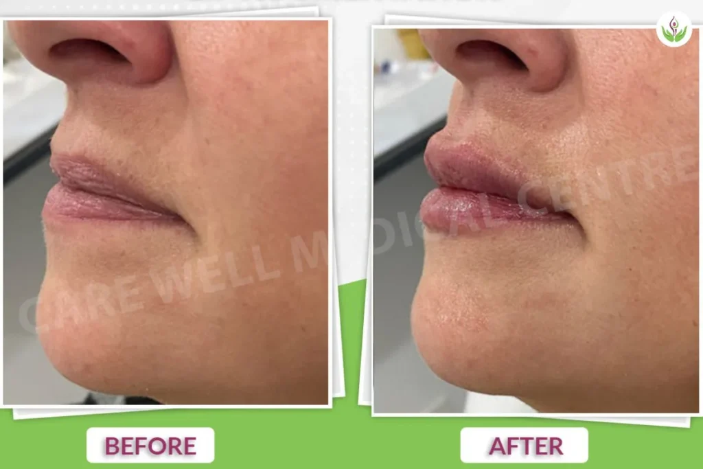 Dermal fillers before and after photo displaying cheek and lip enhancement results.
