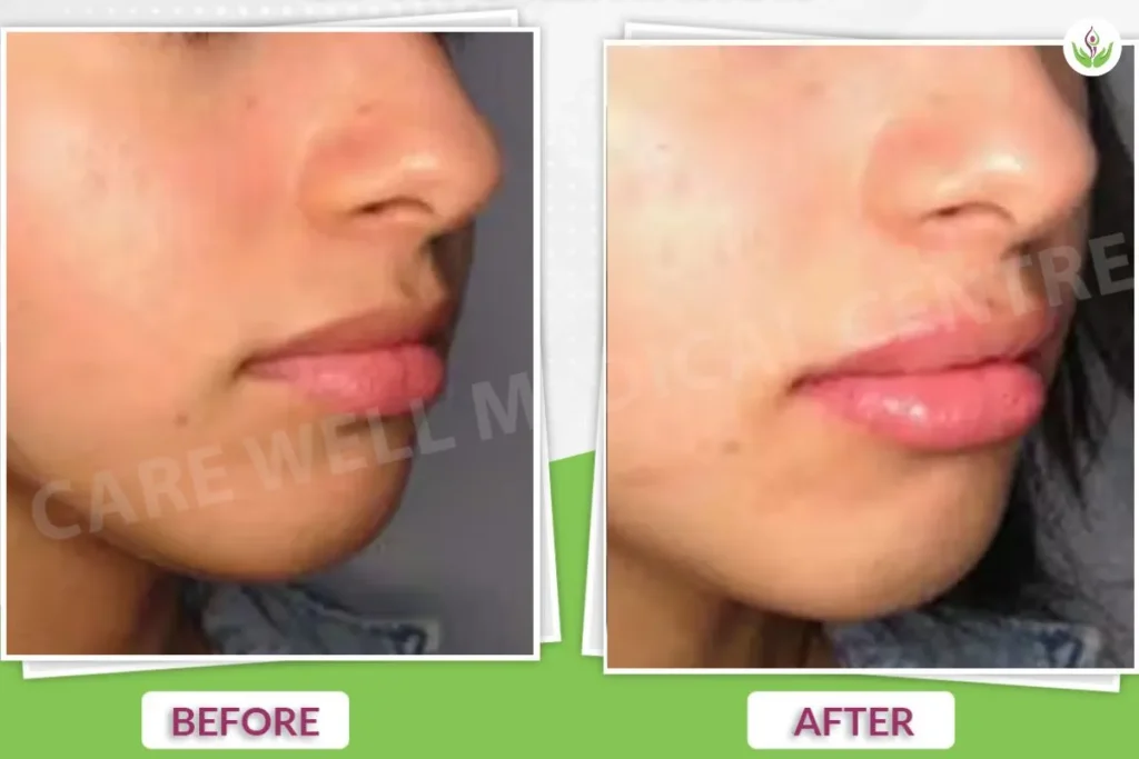 Dermal fillers before and after photo with lip enhancement and smoother skin.