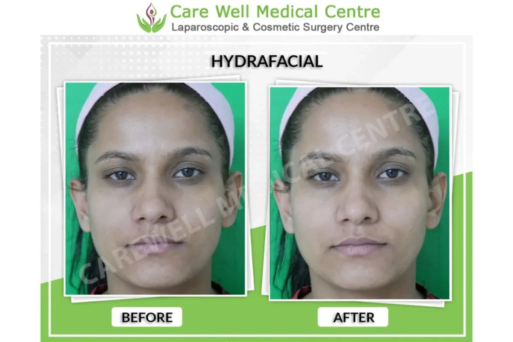 HydraFacial Treatment Before and After Result in Delhi – Glowing Skin Transformation