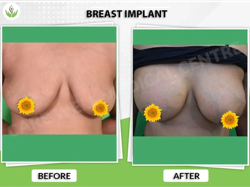 Real breast implant before and after result photo in Delhi with surgery outcome