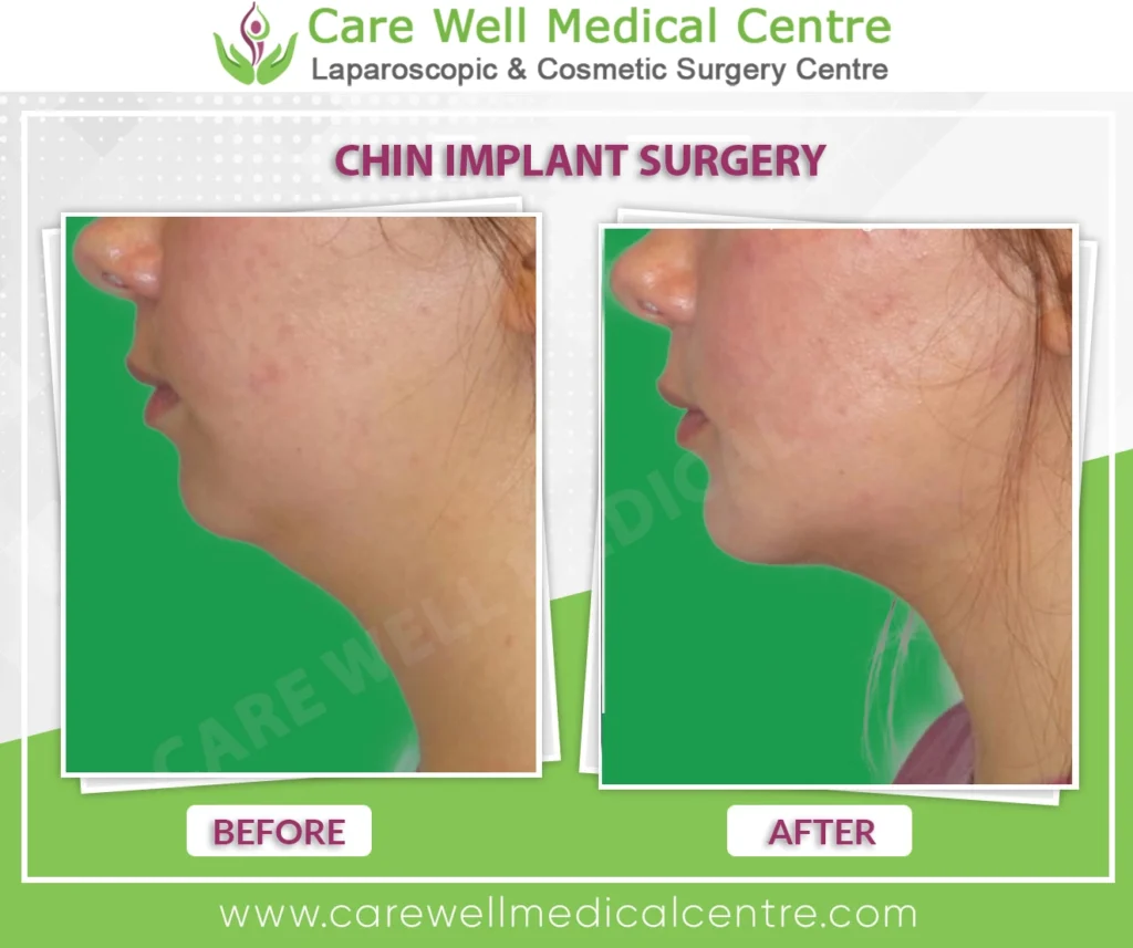 Jawline improvement after chin augmentation